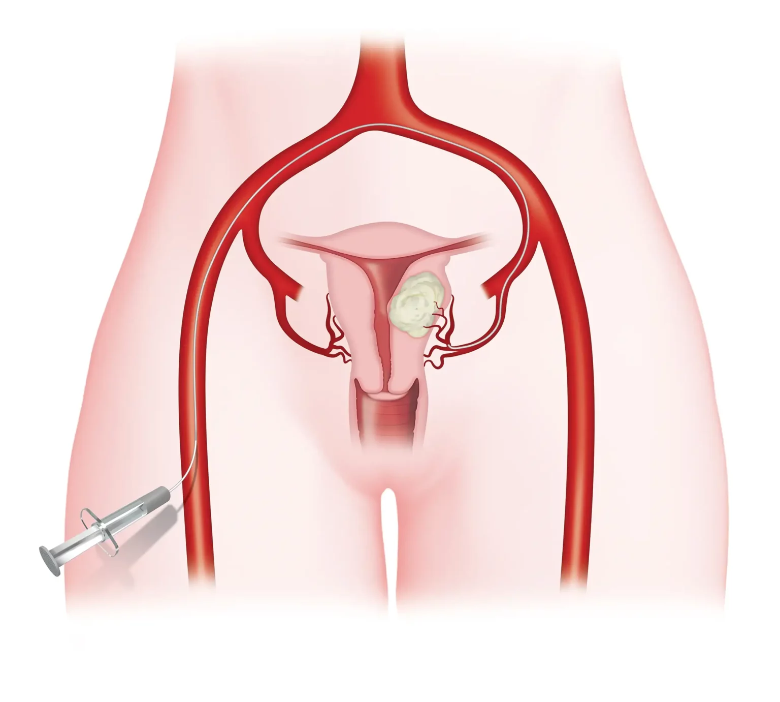 fibroid-awareness